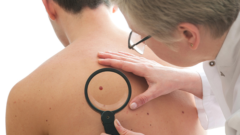 Jesień to najlepszy czas na wizytę u dermatologa. Zbadaj znamiona po lecie, aby wiedzieć, kiedy zwykły pieprzyk wymaga konsultacji